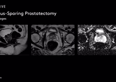 Masterclass in Clipless Retzius-Sparing Prostatectomy: Full Case Demonstration by Intuitive Proctor Mr Wissam Abou-Chedid